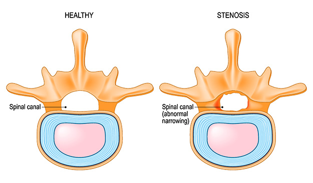 medical illustration of spinal stenosis