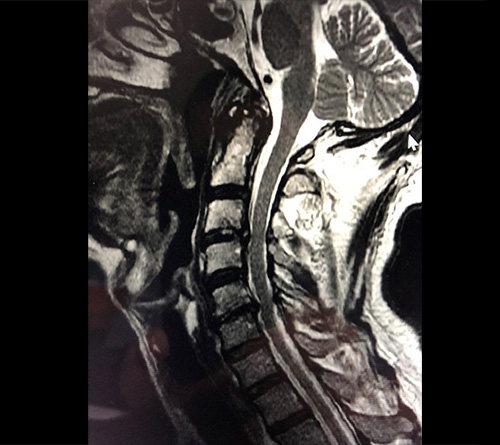 MRI image of cervical spinal stenosis and cord compression