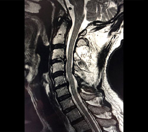 MRI image of decompressed spinal canal after endoscopic surgery