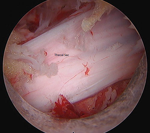 Endoscopic view of lumbar spine post decompression